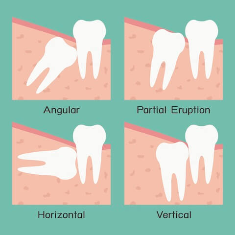 Who Needs Wisdom Tooth Extraction