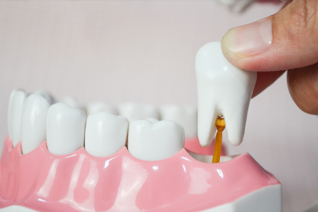 wisdom teeth extraction Removal didsbury alberta