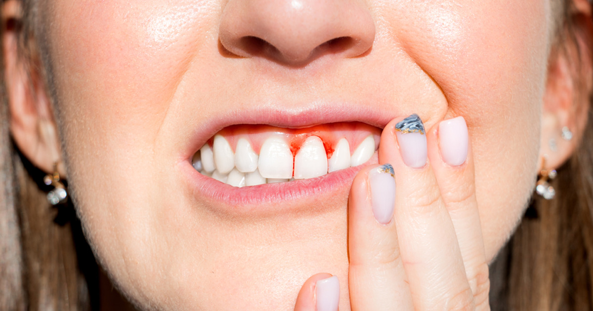 What would cause my gums to bleed – Call Dentist in Didsbury Alberta